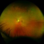 optomap Image showing healthy eye