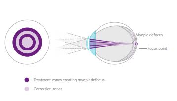Diagram of MiSight treatment zones on an eye